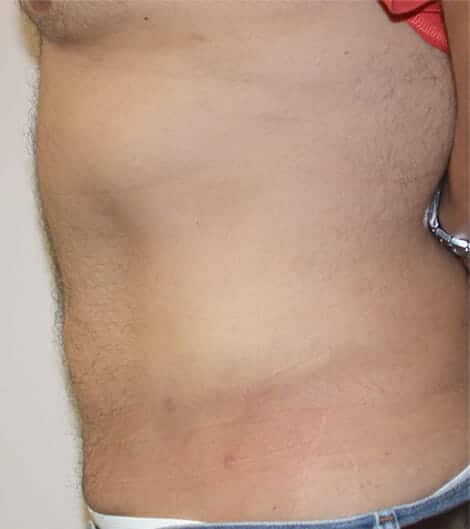 liposuction 1618 - Patient 9