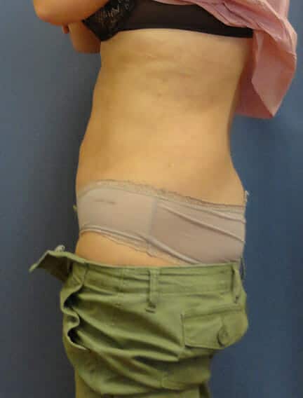 liposuction 1784 - Patient 3