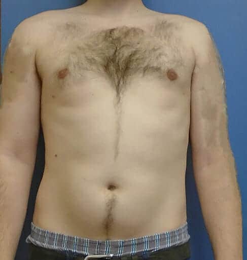 liposuction 1959 - Patient 8