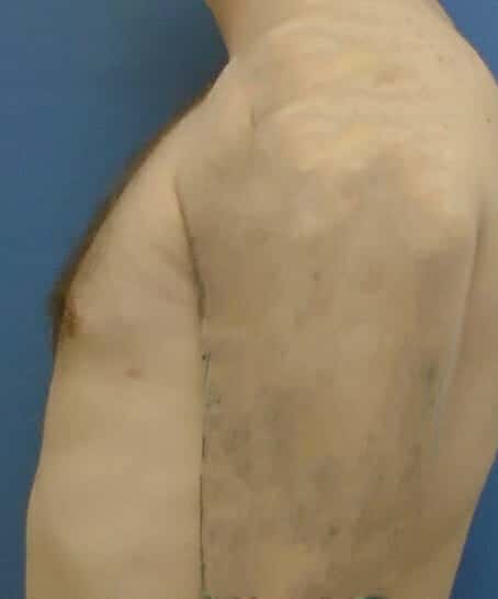 liposuction 1960 - Patient 8