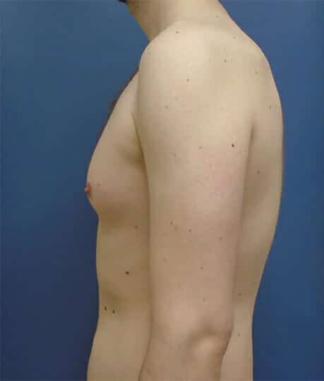 liposuction gynecomastia 1466 1 - Patient 6