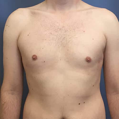 liposuction gynecomastia 1467 - Patient 10