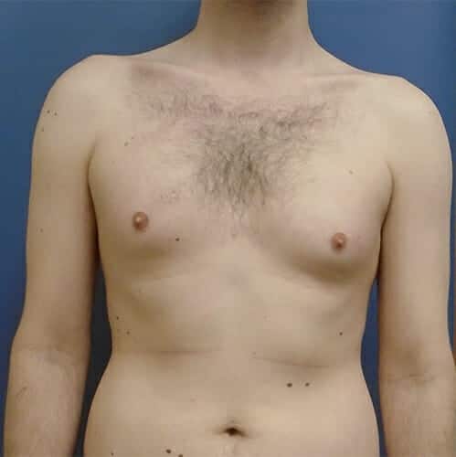 liposuction gynecomastia 1468 - Patient 10