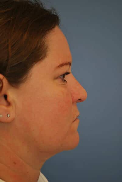 neck liposuction 1728 - Patient 996