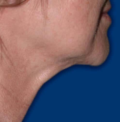 neck liposuction 1733 - Patient 997