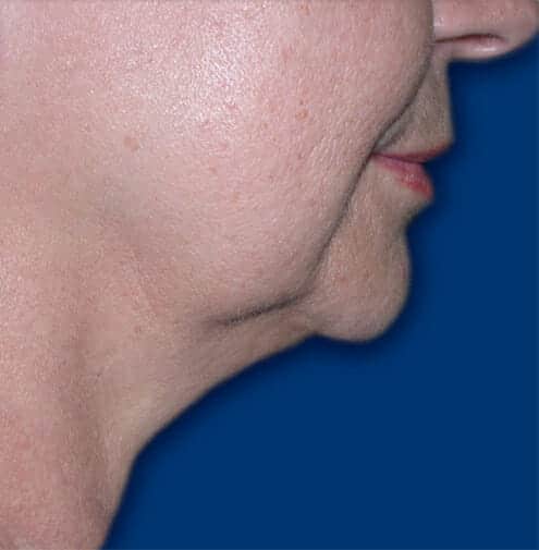 neck liposuction 1734 - Patient 997