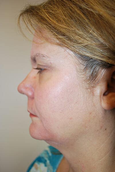 neck liposuction 1743 - Patient 999