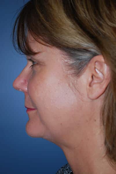 neck liposuction 1744 - Patient 999