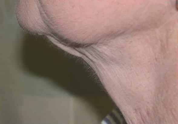 neck liposuction 3061 - Patient 994