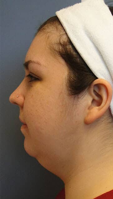neck liposuction 3074 - Patient 990