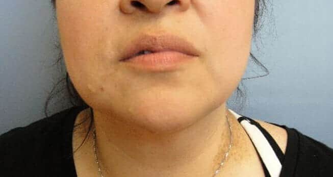 neck liposuction 4561 - Patient 989