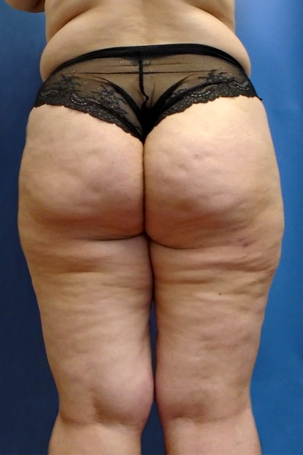 thigh 1 2 - Patient 1