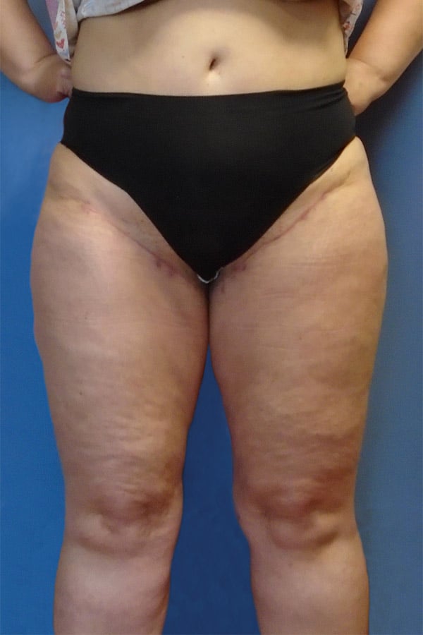 thigh 1 4 - Patient 1