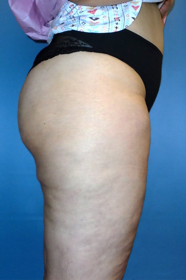 thigh 1 6 - Patient 1