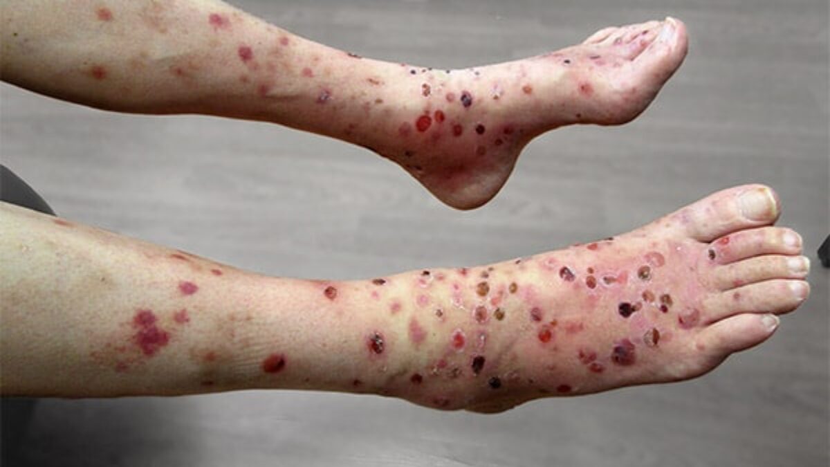 BlisterlegsBefore-copy-1-