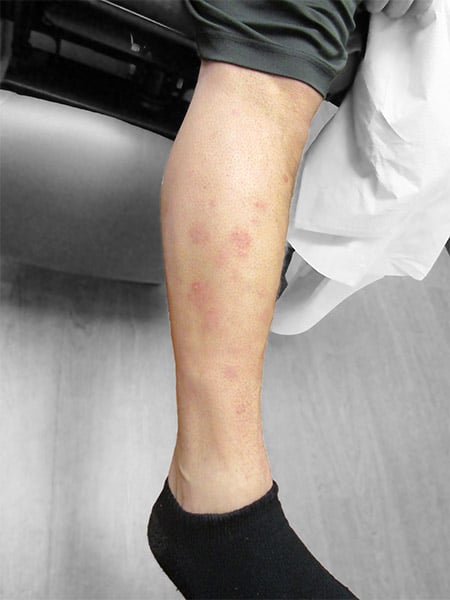 R leg improving on treatment - Patient 995