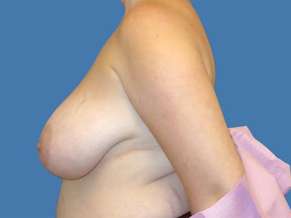 breast 1 5 - Patient 998