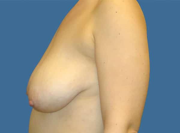 breast lift 3 - Patient 999