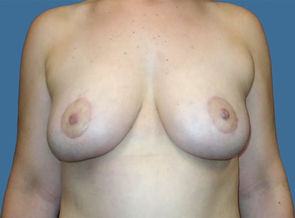 breast lift 4 - Patient 999