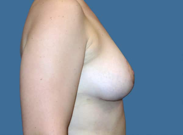 breast lift 6 - Patient 999