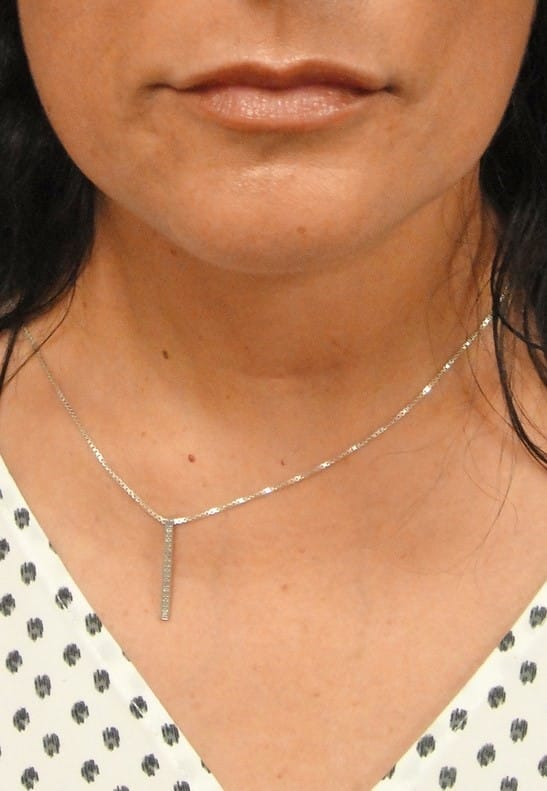 necklift 1 1 - Patient 996