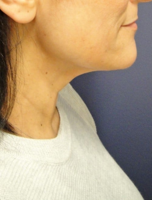 necklift 7 1 - Patient 996