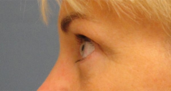 brow after 5 - Patient 990