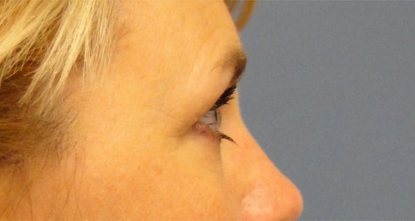brow before 3 - Patient 990