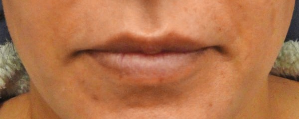 lip after 2 - Patient 998
