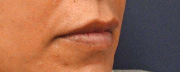 lip after 4 - Patient 998