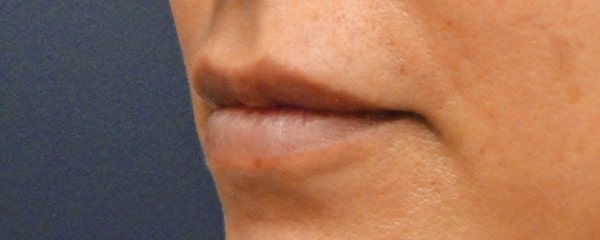 lip after 5 - Patient 998