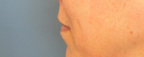 lip before 4 - Patient 998