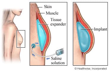 Tissue Expander 01 - Breast Reconstruction