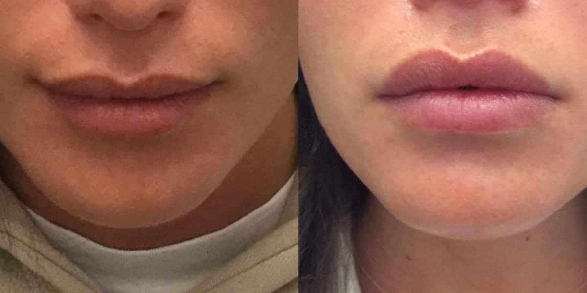 Lip Flip Before and After - Lip Augmentation