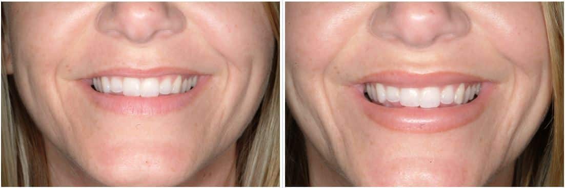 Lip Implant Before and After - Lip Augmentation