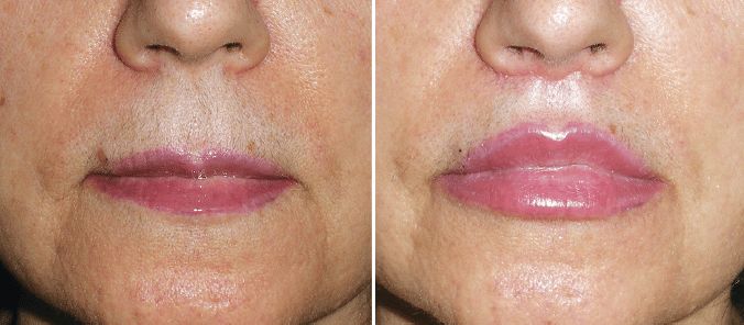 Lip Lift 2 Before and After - Lip Augmentation