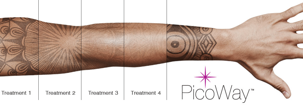 picoway arm logo - Laser Tattoo Removal