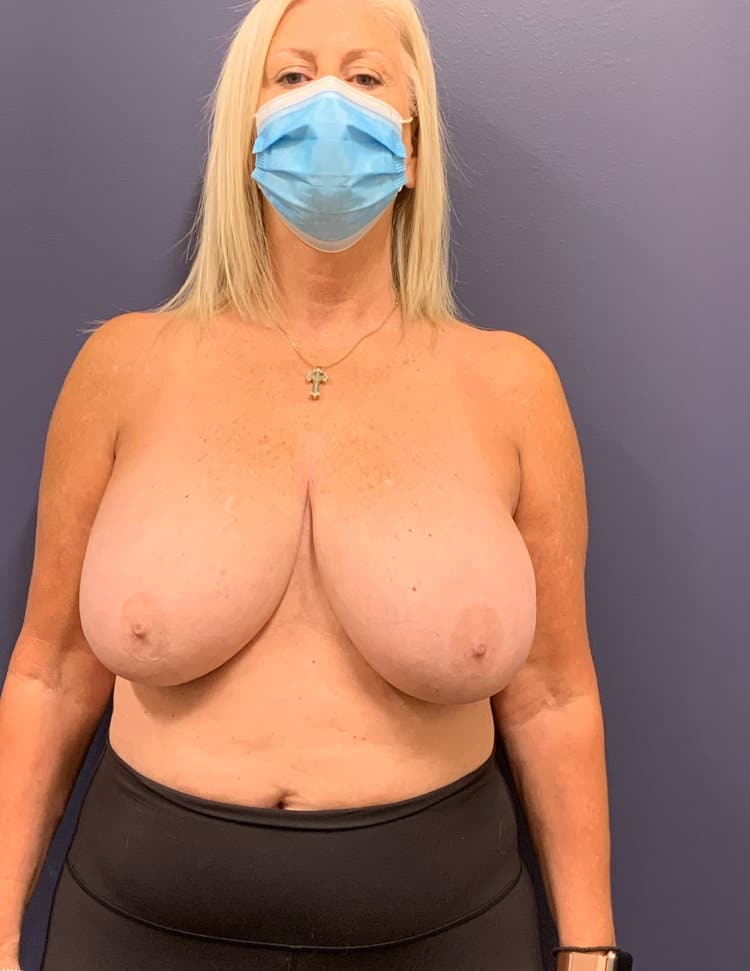 Breast Reduction Before and After