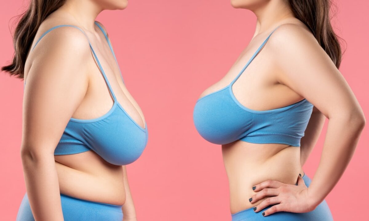 What Can You Do About Saggy Breasts? - Burt & Will Plastic Surgery and  Dermatology