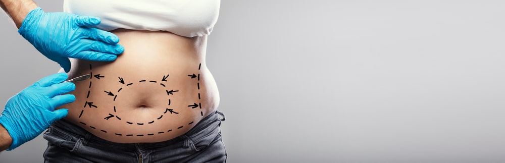 What Is an Abdominoplasty Surgery? | Burt & Will Plastic Surgery and Dermatology