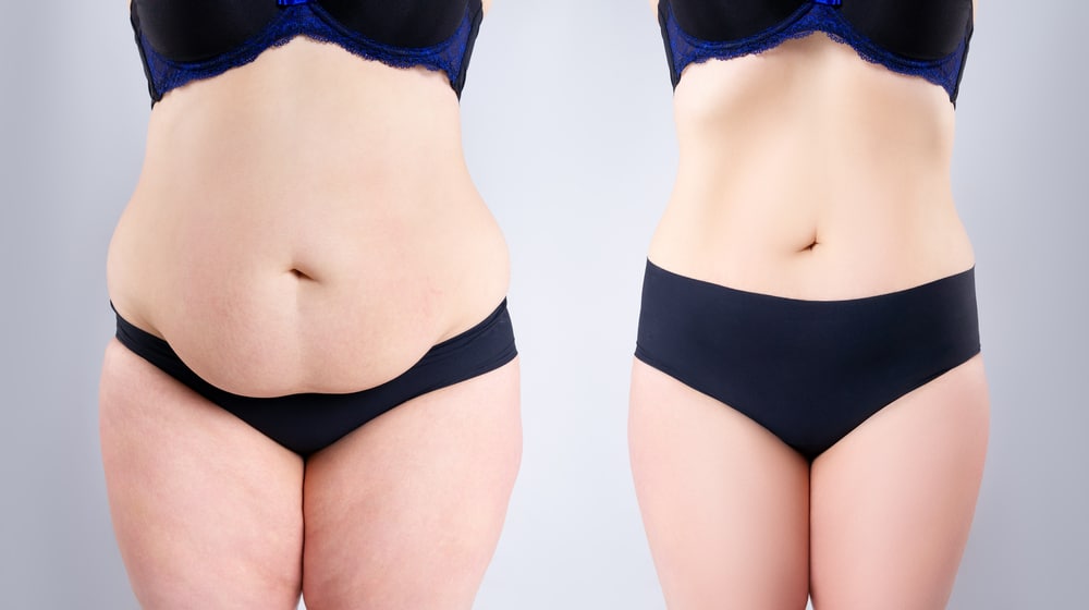 Get Ready for Summer: Look and Feel Fabulous With a Tummy Tuck | Burt & Will Plastic Surgery and Dermatology