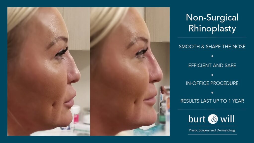 a woman before and after non-surgical rhinoplasty